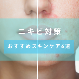 【ニキビ対策】思春期ニキビや大人ニキビと向き合うための方法とおすすめのスキンケア商品6選